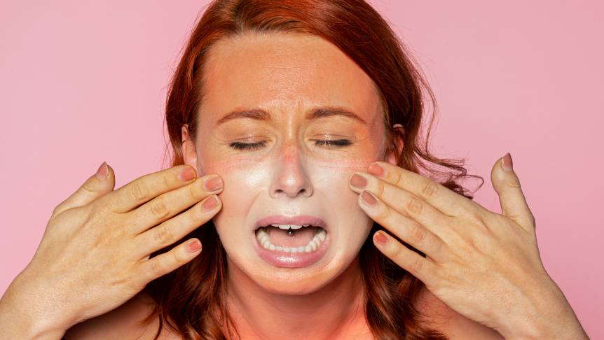 Sunburn due to Ultraviolet Radiation