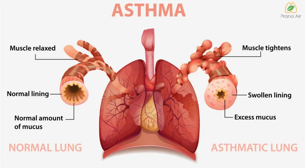 asthma affected lung