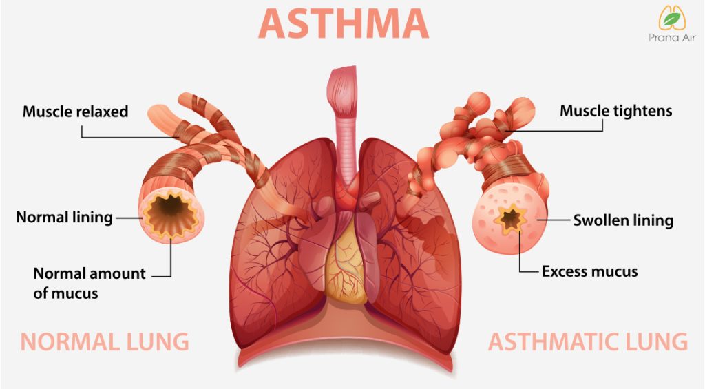 asthma affected lung