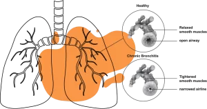 reduced lung function due to ozone