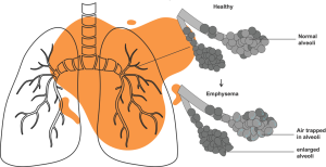 respiratory tract irritation due to ozone