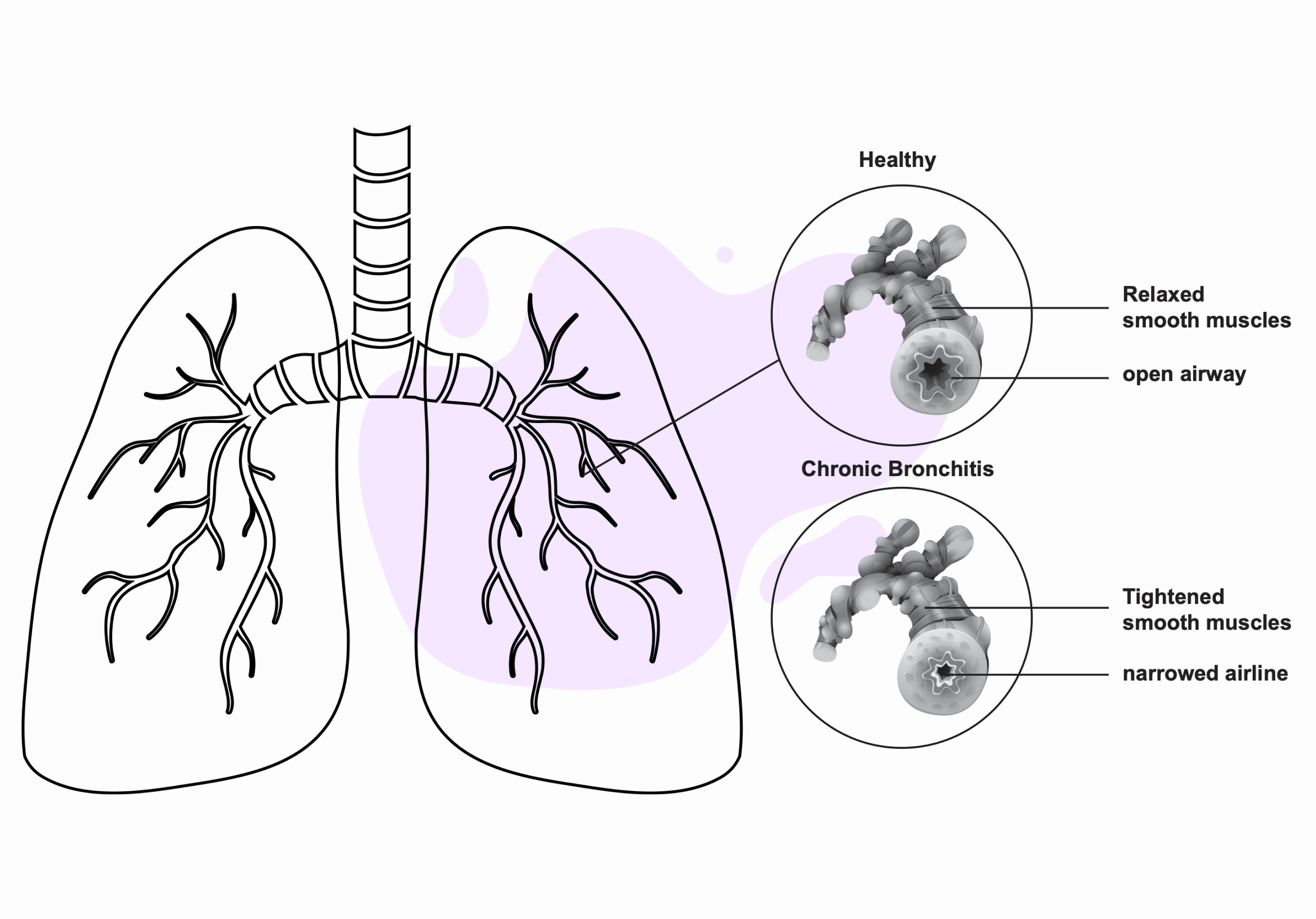 reduced lung function due to ozone