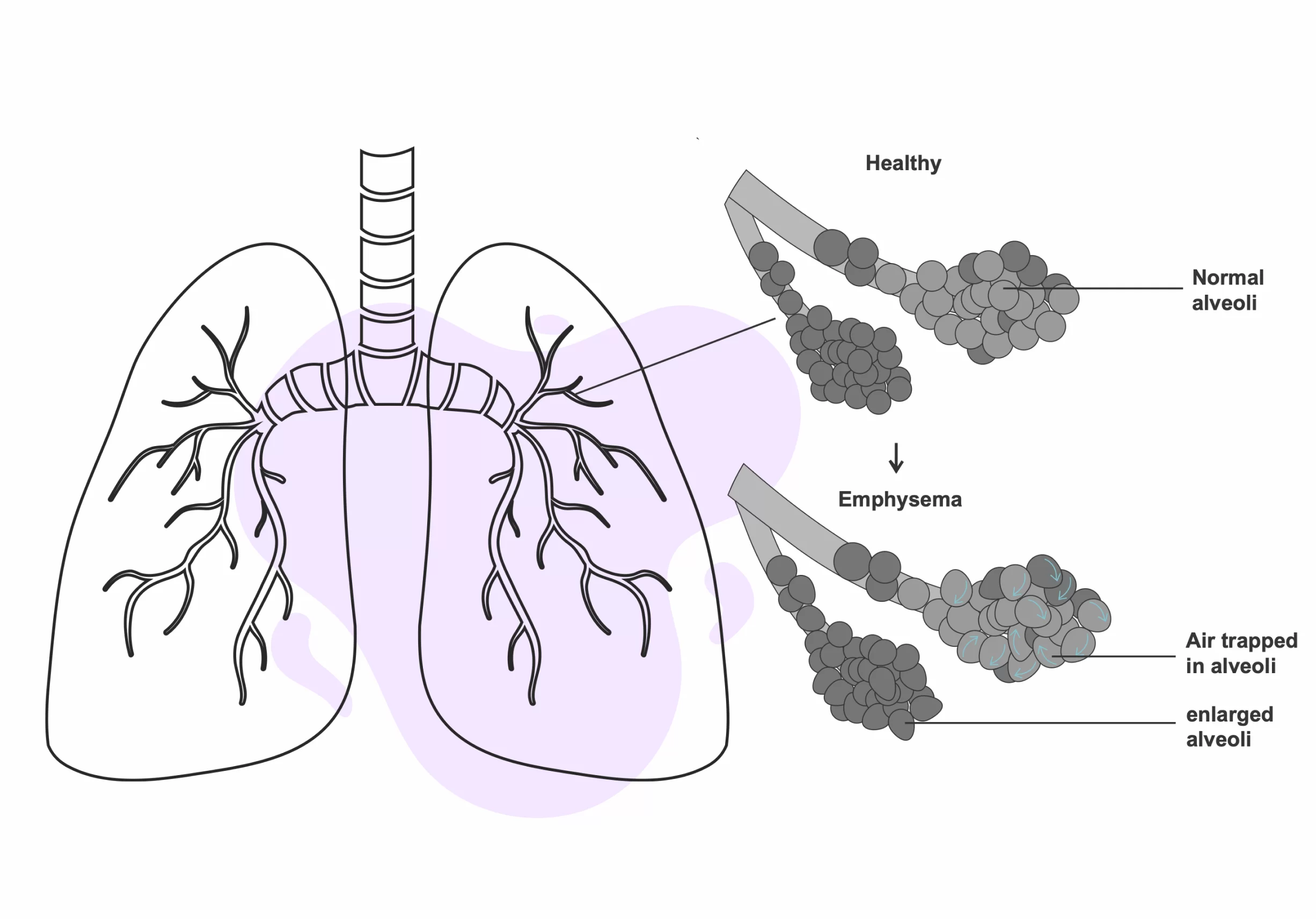 respiratory tract irritation due to ozone